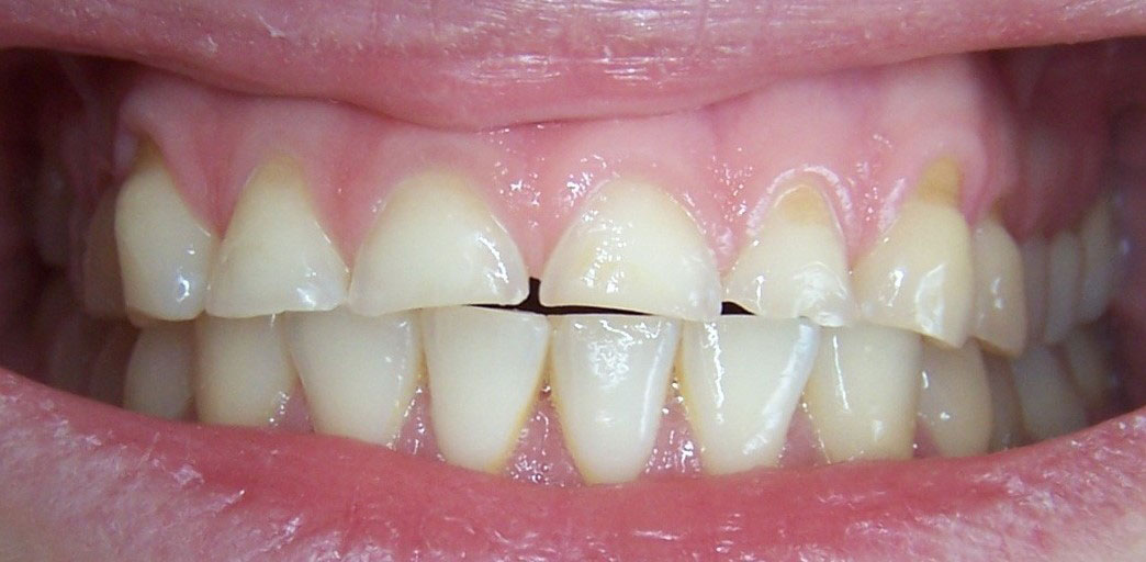 Ästhetische Zahnheilkunde vorher